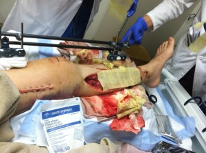 Bilateral fasciotomy, five days after initial surgery.