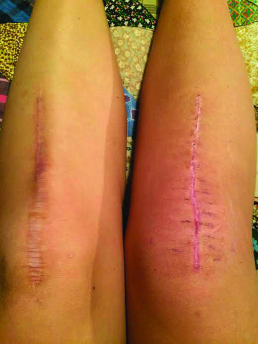 Right knee one month and one week after surgery.